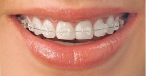 Ceramic Braces