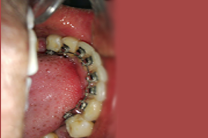 Lower Teeth with Braces