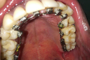 Upper Teeth with Braces